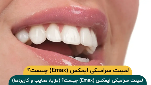 لمینت-سرامیکی-ایمکس-چیست؟